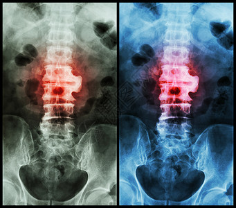 强直性脊柱炎Spondylsis薄膜X射线脊椎 在L23时显示spondylsis病人x射线解剖学医生椎骨骶骨骨干躯干脊椎动物骨科背景