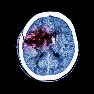 血低落的状态脑部CT扫描 用脑水肿显示旧右直脉冲突出血 脑外科手术后状态 出血中风病人攻击创伤神经射线切除术大脑诊断外科神经病背景