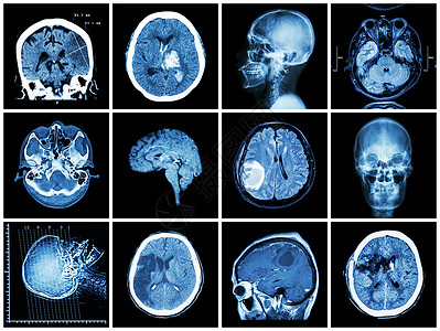 脑部疾病的集合 脑部 CT 扫描和 MRI 显示脑梗塞 脑出血 脑肿瘤 基底神经节出血 开颅术后状态 保健概念科学中风大脑电脑x背景