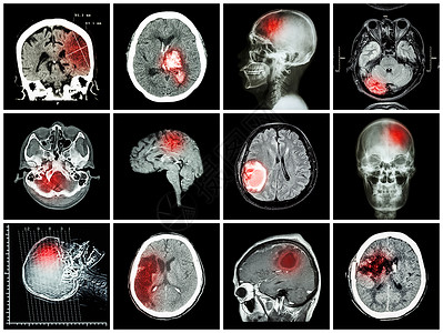 脑部疾病的集合 脑部 CT 扫描和 MRI 显示脑梗塞 脑出血 脑肿瘤 基底神经节出血 开颅术后状态 保健概念中风诊断神经病电脑背景
