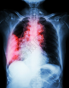 胸腔积液肺癌 电影胸腔X光显示右肺部质量 宽度介质 肺炎和右胸膜破损射线放射科疾病感染扫描解剖学病人积液x射线肿瘤背景