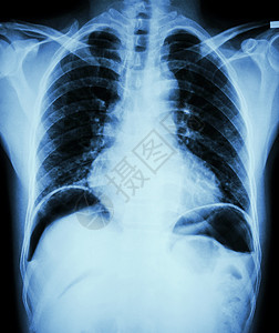 消化性溃疡穿孔 胸部X光片显示由于胃溃疡或十二指肠溃疡穿孔漏气 双隔膜圆顶下游离空气 手术条件和概念外科扫描医院疾病腹痛保健射线背景图片