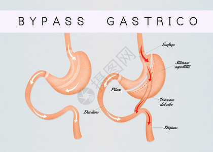 胃旁路手术肠胃绕行方案器官插图饮食外科减肥肥胖保健肠子手术背景