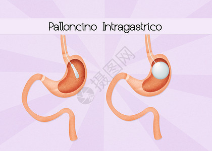 内气气球饮食肠子器官外科卫生保健小袋肥胖插图可调背景图片