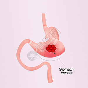 胃癌胃炎冒号癌症外科医疗粘膜手术放射科器官插图背景