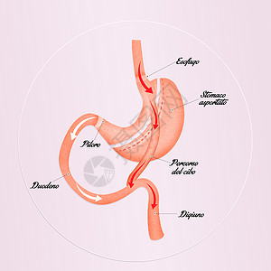 胃旁路手术减少胃部的胃道切除术卫生手术减肥肥胖肠子饮食保健外科器官插图背景