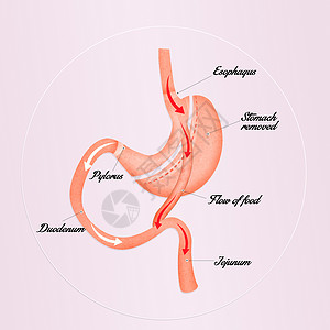 胃旁路手术肠胃绕行计划背景