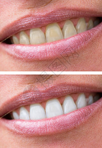 妇女白前和白后牙齿牙科治疗创意幸福概念女性女士假牙嘴唇美白背景图片
