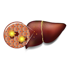 肝脏细胞被毒素攻击的肝细胞坏死小叶组织纤维化肠胃细胞癌症保健解剖学代谢背景