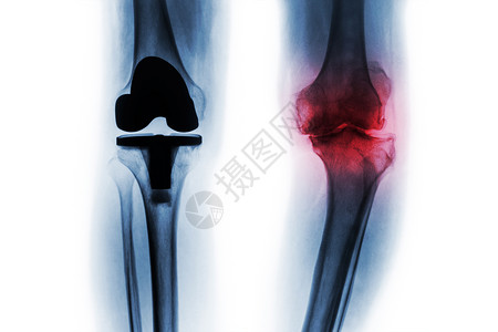 骨眼关节炎膝部和人工关节的X光片完全更换膝盖 孤立的背景治疗股骨x光成形术手术大腿疾病扫描x射线骨科背景
