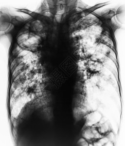 肺结核 胸部 X 光片显示由于结核分枝杆菌感染导致双肺纤维化 空腔 间质浸润躯干医院诊断扫描肋骨x射线身体细菌肺炎药品背景图片
