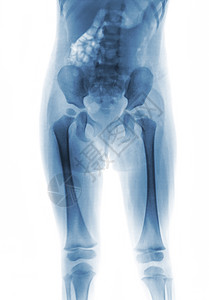 宝宝骨骼儿童影片X光体身体下半部大腿臀部躯干腰椎腰部骨盆x光股骨婴儿蓝色背景