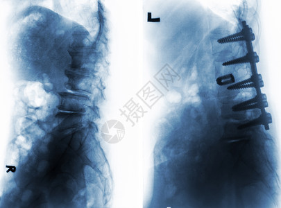 骨科手术外科手术前后的脊柱性硬化症身体疾病卫生经营射线疼痛扫描腰部椎骨金属背景