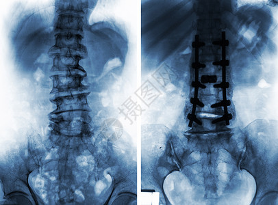脊柱炎外科手术前后的脊柱性硬化症射线脊椎放射科x射线脊柱金属疾病腰椎身体治疗背景