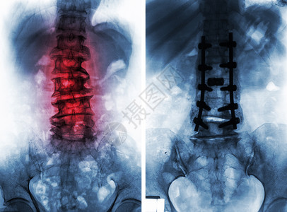 脊椎侧弯素材外科手术前后的脊柱性硬化症保健脊柱腰部腰椎治疗椎骨疼痛经营金属放射科背景