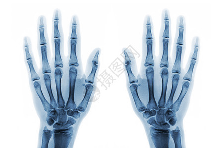 倒置X光片两只手都用白色背景显示正常人手孤立放射科数字病人电影风湿诊断x光医院前臂棕榈背景