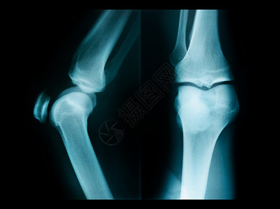 腓骨X光照片显示膝关节背景