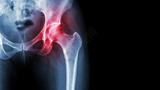x型腿髋关节关节炎 X 光片显示右侧髋关节和空白区域发炎 缺血性坏死概念药品风湿关节炎外科疾病蓝色手术痛风扭伤骨关节炎背景