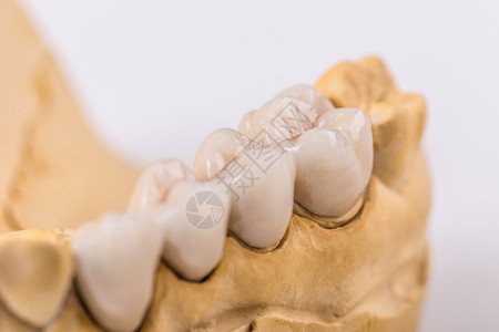 牙龈炎陶瓷制成的假体模仿白色医生牙齿牙科凹痕构造假牙假肢背景