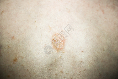 脂溢性脱发特应性皮炎 皮肤上的湿疹背景