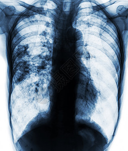 肺结核感染导致右肺渗透到右肺部的胸透片X光片片片段x光射线空腔肺炎身体细菌x射线男人胸部蓝色背景