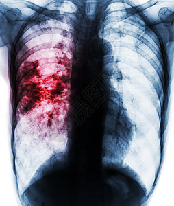 肺结核感染导致右肺渗透到右肺部的胸透片X光片片片段x光x射线解剖学诊断疾病射线细菌病人结核蓝色背景
