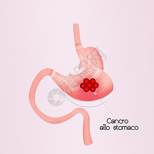 胃癌消化系统药品考试医疗粘膜放射科手术胃炎方案器官背景图片