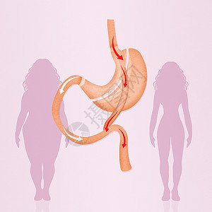 肠胃外科手术减肥饮食肠子方案保健卫生器官插图肥胖背景图片