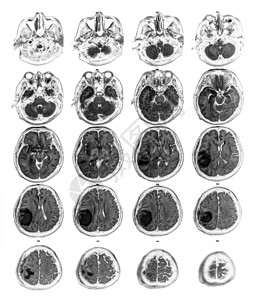 大脑ctMRI脑部显示右皮骨叶上的脑瘤神经病x射线医院神经元中风颅骨电脑诊断大脑脑血管背景