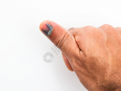 男性手事故的伤痕指甲高清图片