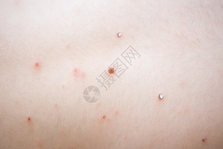皮肤病变小孩身上长水痘过敏宏观躯干儿科麻疹颠簸传染性疱疹划痕皮肤背景