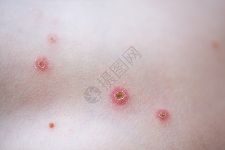 小孩身上长水痘粉刺躯干疾病疱疹感染孩子身体表皮麻疹发痒背景图片