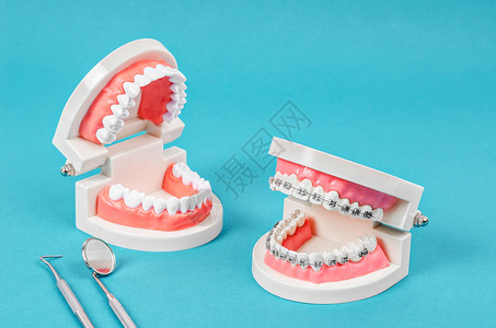 嘴咬将牙齿模型和牙模型与金属铁线牙牙套作比较治疗手术夹子牙科蓝色报销牙医诊所矫正健康背景