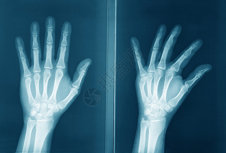 放射線人类手的原始放射线手指外科手臂概念医院药品放射科掌骨收音机诊断背景