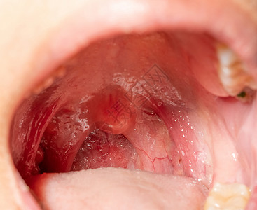 软腭口咽部咽喉痛高清图片