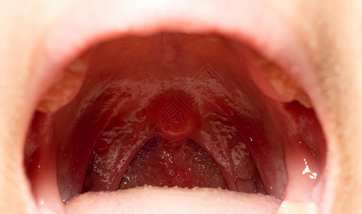 口咽部亚洲人扁桃体高清图片