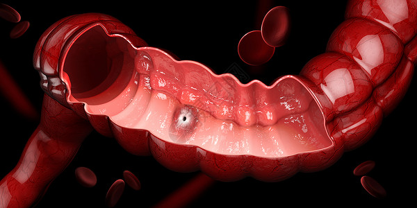 胃溃疡 3D 说明人类胃解剖背景图片