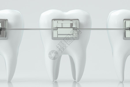 三齿蕚野豌豆牙科牙套和牙齿 3D缝合搪瓷凹痕反射磨牙治疗生物学金属卫生制品渲染背景