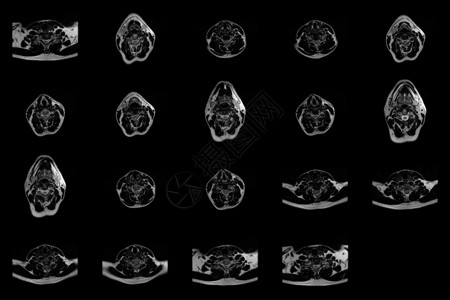在C6-C7区段的双准中间介质外溢 并进行放射细胞病理学检查时 对caucasian 男性颈部区域进行一套横向MRI扫描背景图片