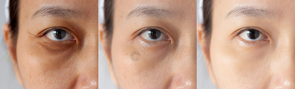 眼周肌肤三张图片治疗前后效果对比 黑眼圈 浮肿 眼周皱纹问题前后治疗 解决肌肤问题 改善肌肤背景