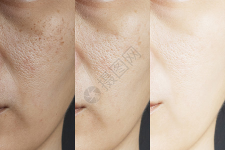 色斑暗沉三张图片治疗前后效果对比 治疗前后有雀斑 毛孔 暗沉 皱纹等问题的皮肤 解决皮肤问题 达到更好的皮肤效果背景