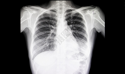 肺炎胸胸片背景