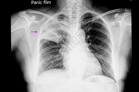 胸部对比洛巴肺炎医生身体脑叶电影病理辐射抗生素感染胸椎解剖学背景
