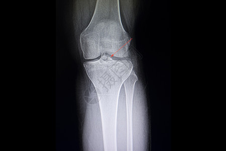 脊柱骨折脊椎骨折质结柱膜临床骨科膝盖电影腓骨脊柱治疗胫骨药品末端背景