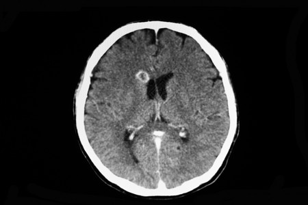 对脑出血的病人进行CT扫描高清图片