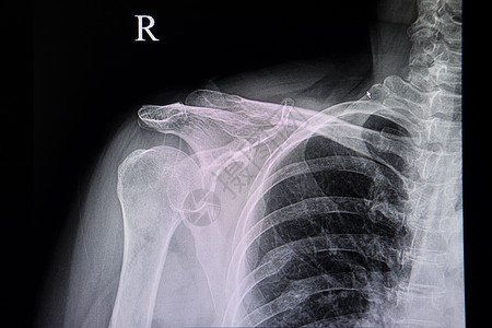 一名有旧肋骨骨折的病人的胸部X光片高清图片