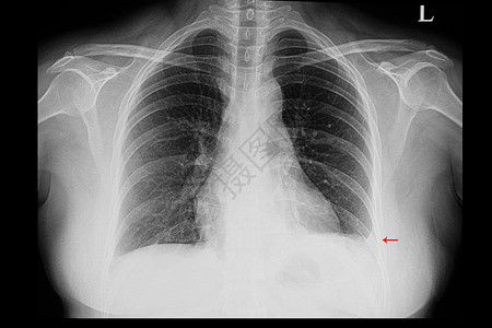 胸腔积液左胸腔破损的病人胸部X光片扫描身体胸椎医生诊断放射科射线骨骼解剖学药品背景