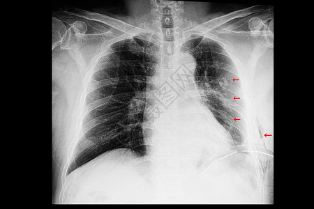 对肋骨骨折和胸膜骨折的病人进行胸部X光检查高清图片