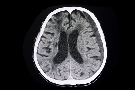 黑色线性CT 脑子亚急性下硬体血肿背景