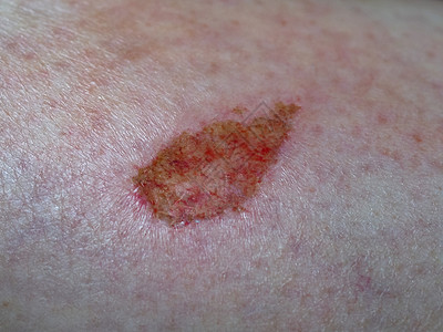 伤疤组织保健感染伤口皮肤疤痕瘢痕医疗真皮药品手臂高清图片